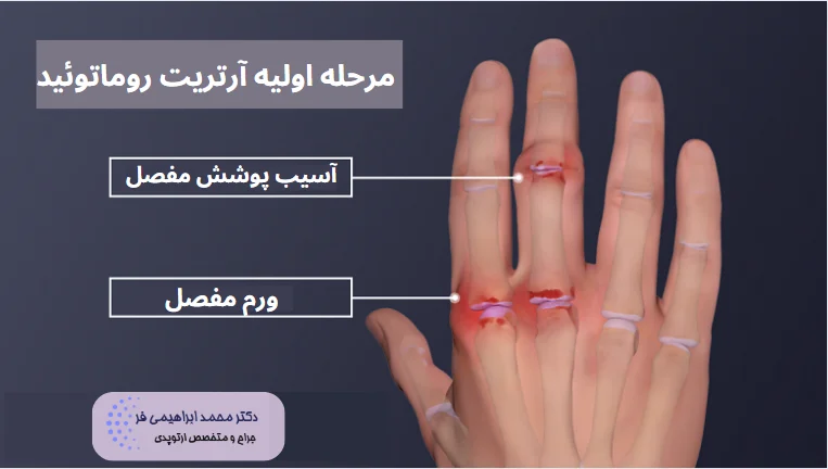 مرحله اولیه آرتریت روماتوئید