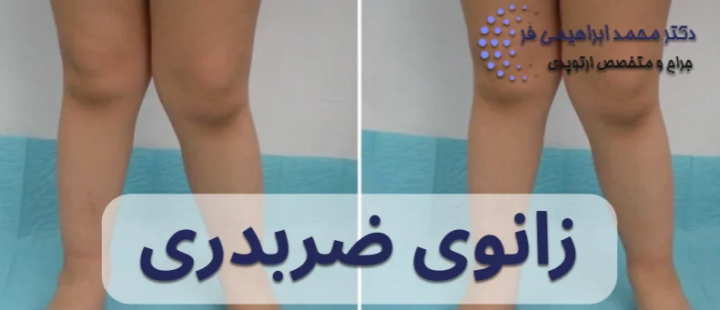 زانوی ضربدری