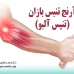 درمان آرنج تنیس بازان