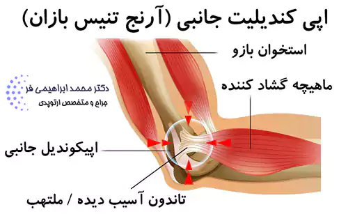 تنیس البو یا اپی ‌کندیلیت جانبی